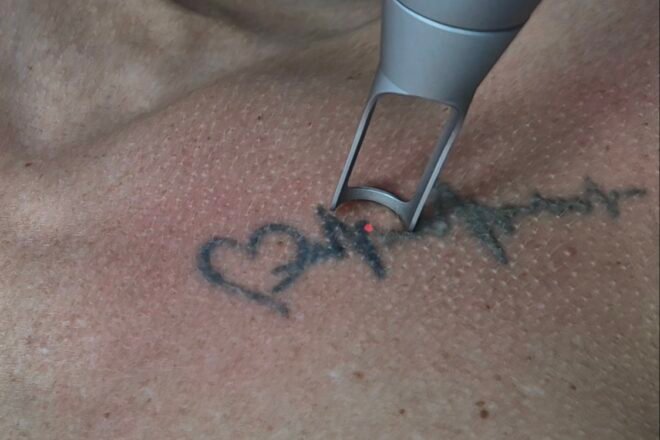tattoo removal Liverpool, laser hair removal Liverpool, laser hair removal, tattoo removal